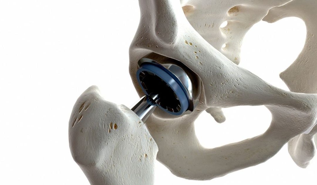 Artroplastia de cadera: ¿Qué es y para qué sirve?