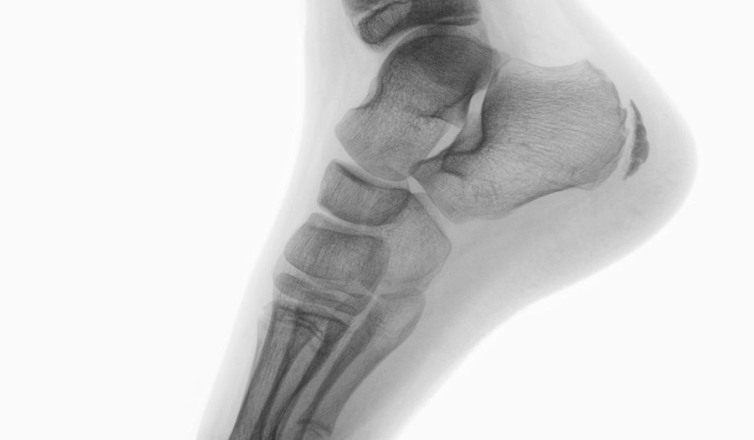 imagen de radiografía de pie con espolón calcáneo